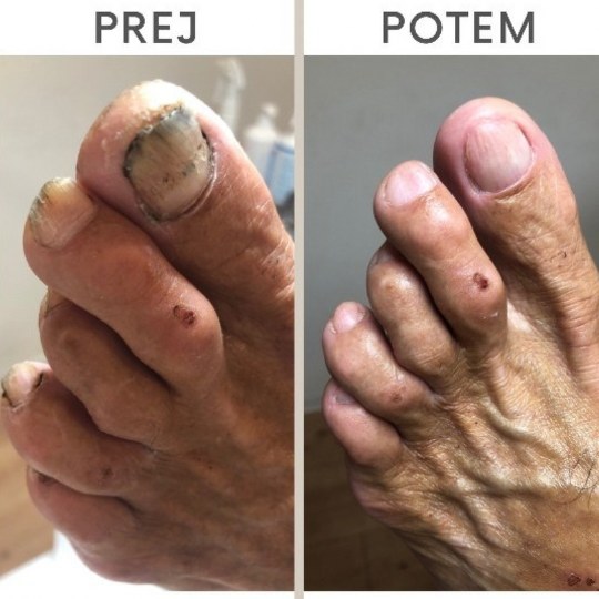 Medicinska pedikura Lepotni center Aloe Vera Ljubljana - Prej/Potem