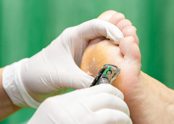 Kako odstraniti otiščanec?