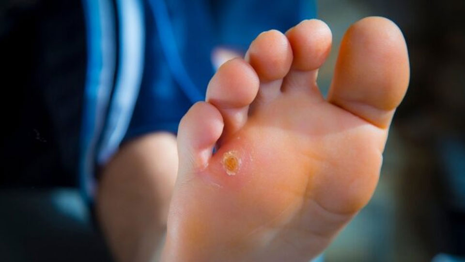 Kurje oko in otiščanec: Zakaj nastaneta in kako ju odstraniti?