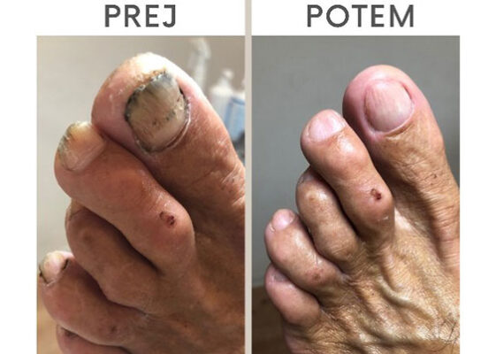 Medicinska pedikura za zdravje vaših stopal